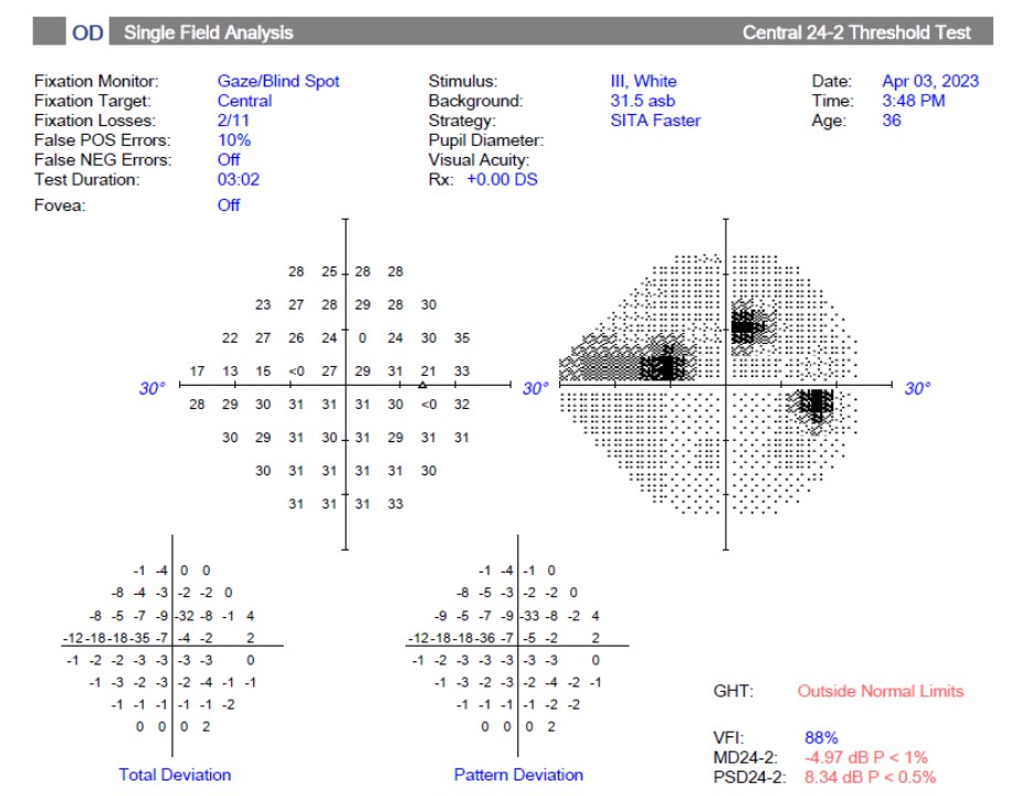 Visual field Pre Nutravsion PP