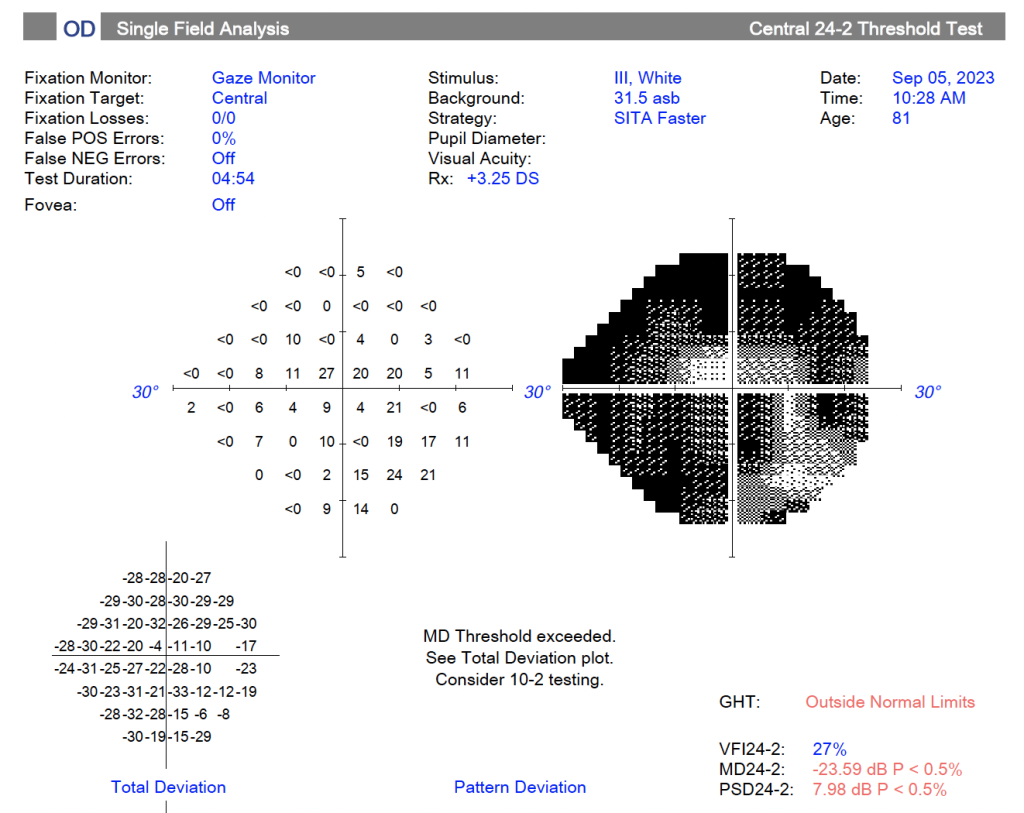 Improved visual field after Nutravision